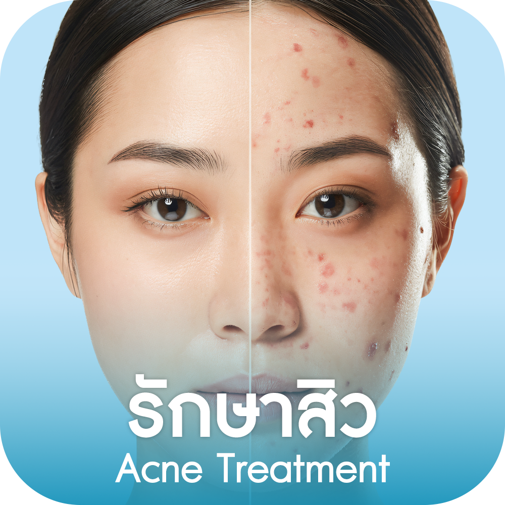 รักษาสิว